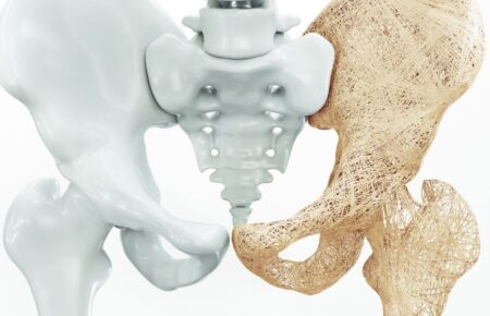 Vsesvitniy den profilaktyky osteoporozu