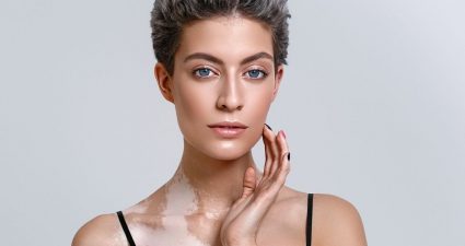 Всесвітній день вітиліго