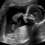 Міжнародний день ненародженої дитини